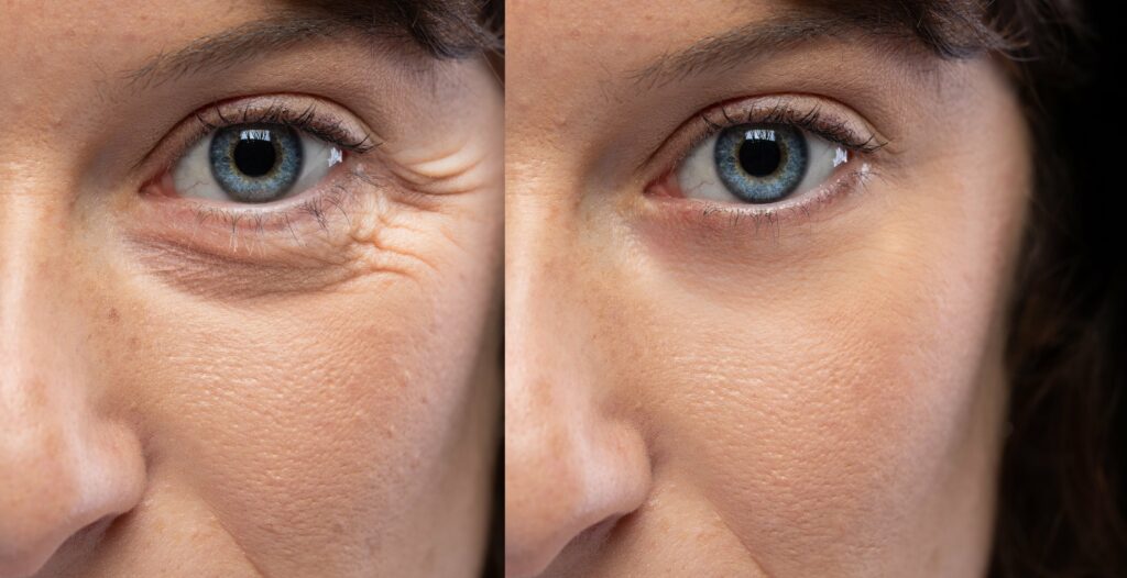 Before and After Wrinkle Treatment under eyes | Vivant Med Spa | Itasca, Illinois